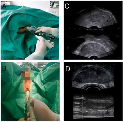 Comparison of a Personalized Prostate Biopsy Pattern With Traditional Transrectal Prostate Biopsy: Different Cancer Detection Rate